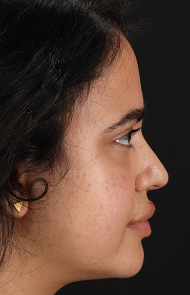 Before - right_lateral