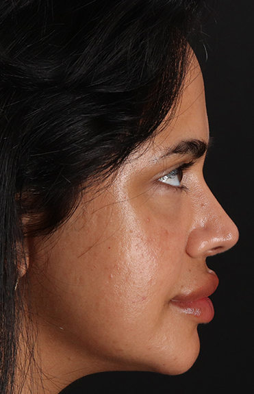 After - right_lateral