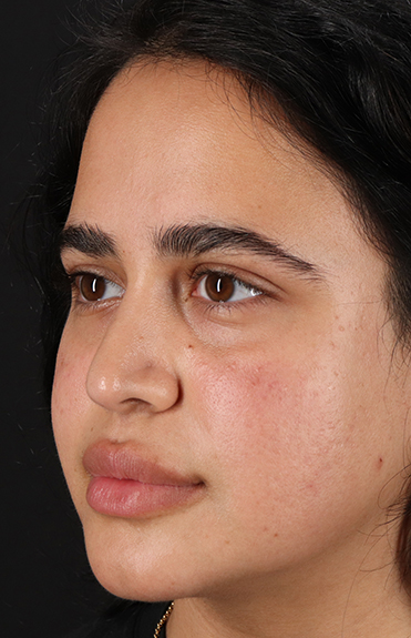 Before - left_oblique