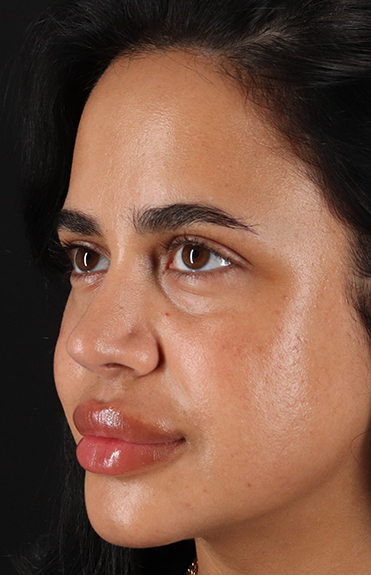 After - left_oblique