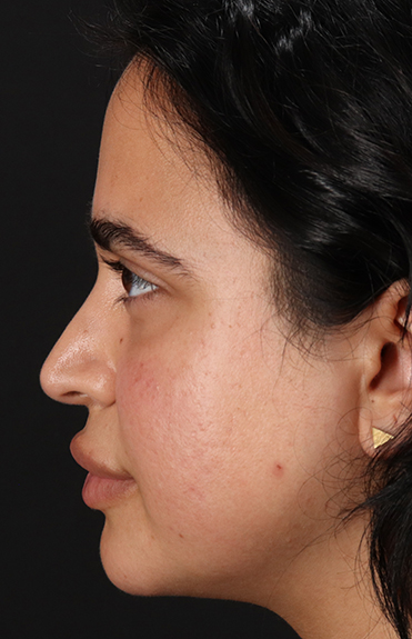 Before - left_lateral