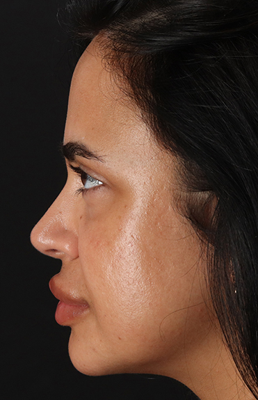 After - left_lateral