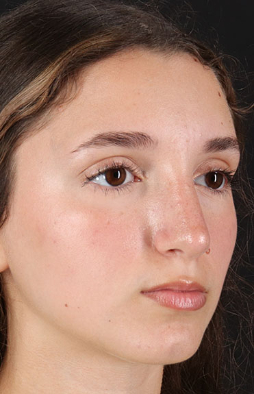 After - right_oblique