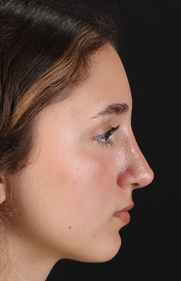 After - right_lateral