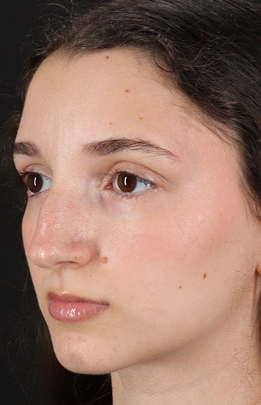 Before - left_oblique