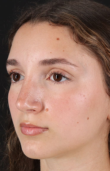 After - left_oblique