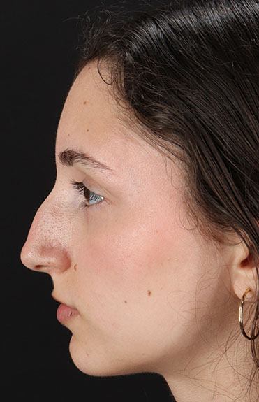 Before - left_lateral