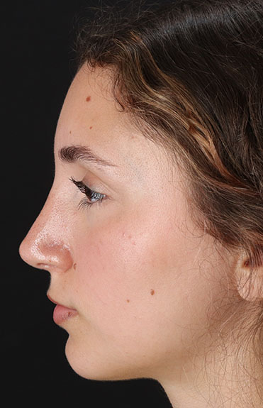 After - left_lateral