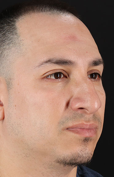 Before - right_oblique