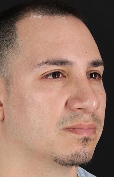 After - right_oblique