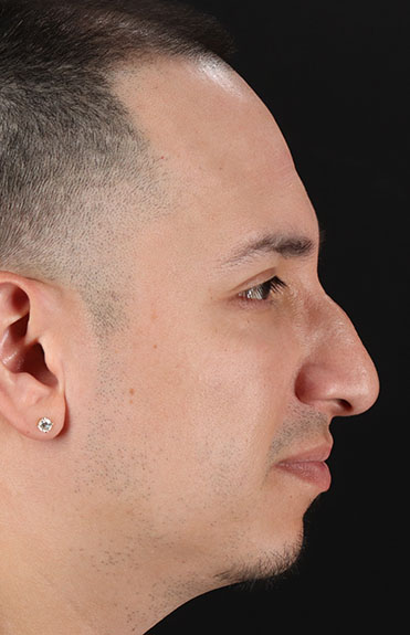 Before - right_lateral