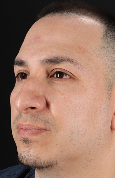 Before - left_oblique