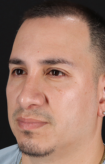 After - left_oblique