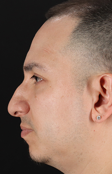 Before - left_lateral