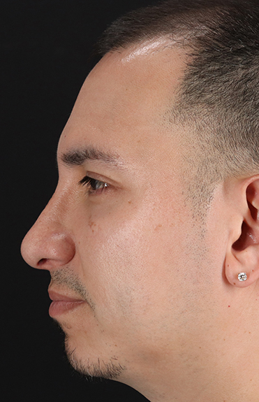 After - left_lateral