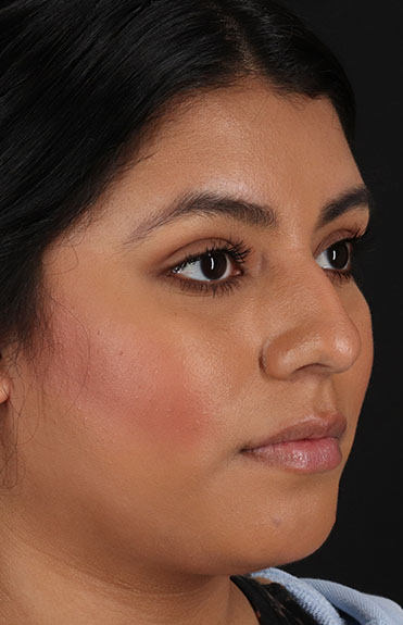 Before - right_oblique