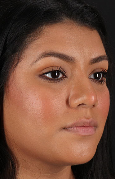 After - right_oblique