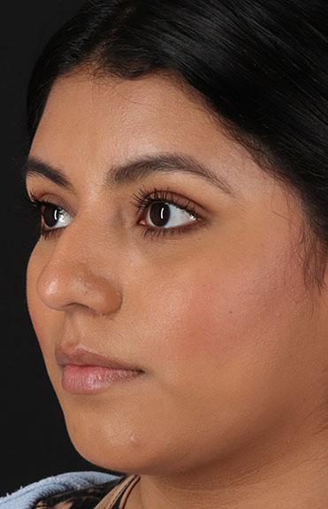 Before - left_oblique