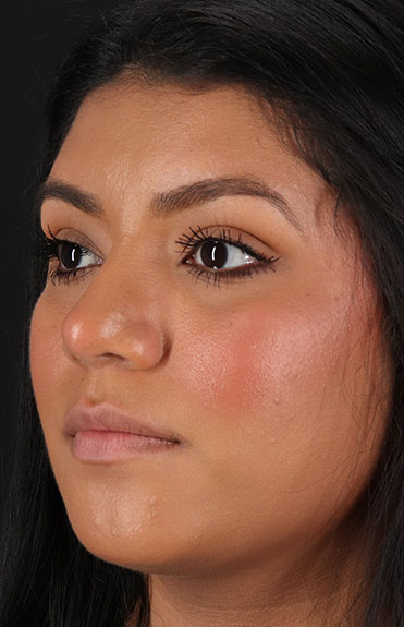 After - left_oblique