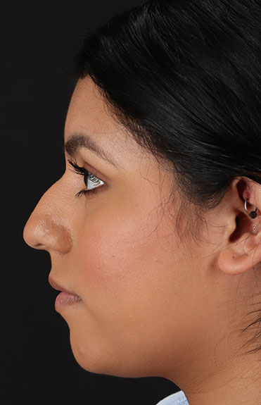 Before - left_lateral