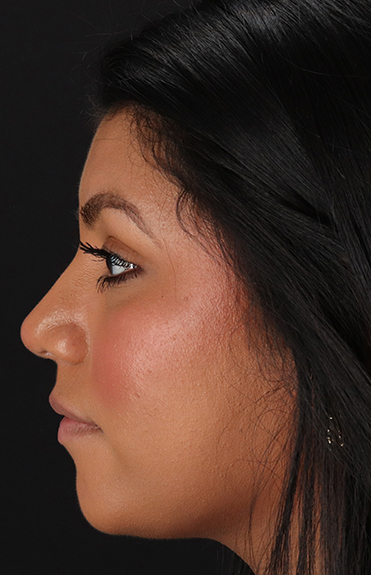 After - left_lateral