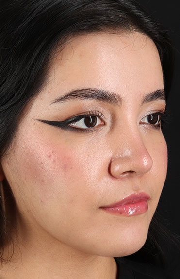 After - right_oblique