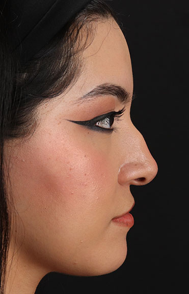 Before - right_lateral