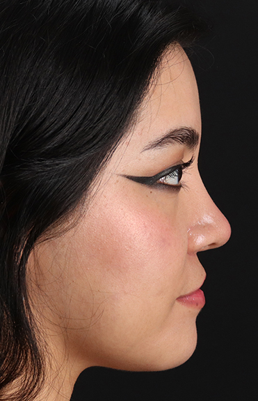 After - right_lateral