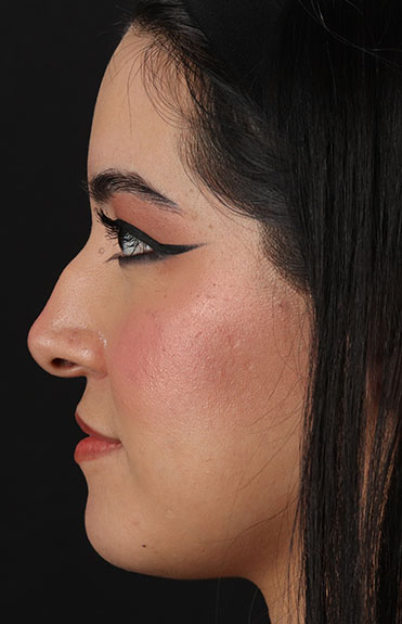 Before - left_lateral