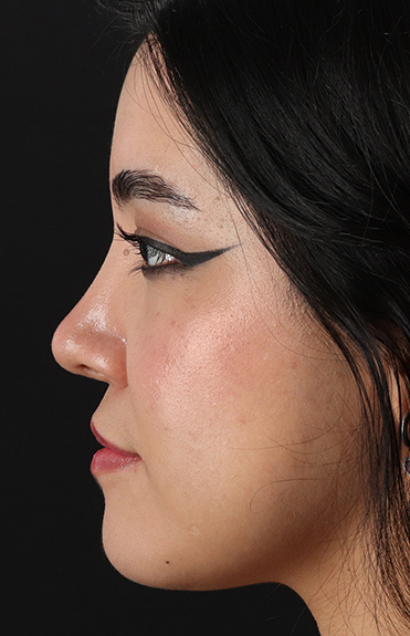 After - left_lateral