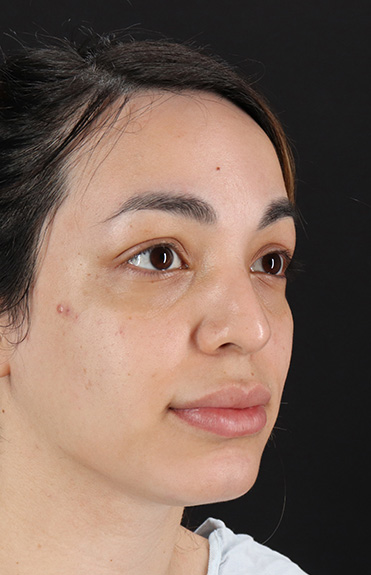 Before - right_oblique