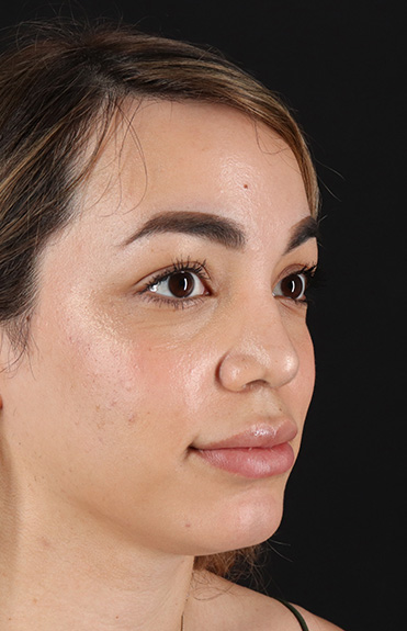 After - right_oblique