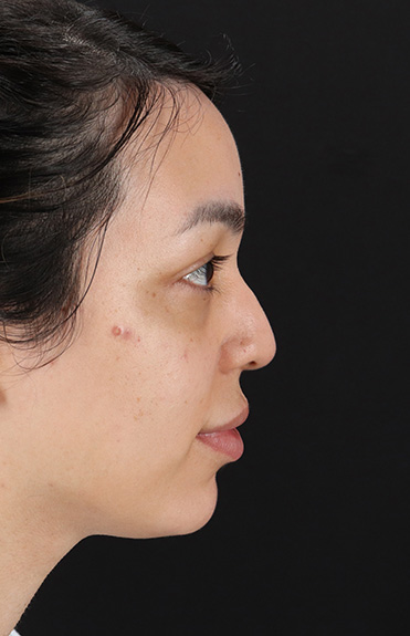 Before - right_lateral