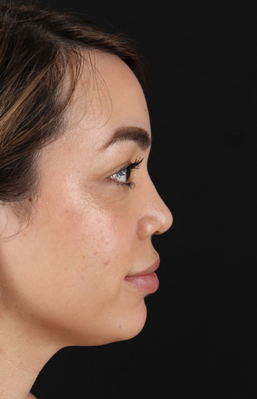 After - right_lateral