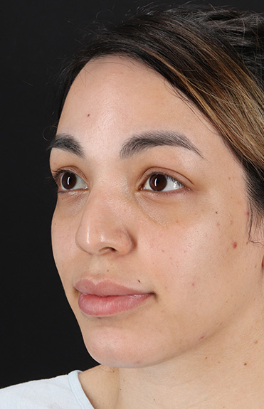 Before - left_oblique