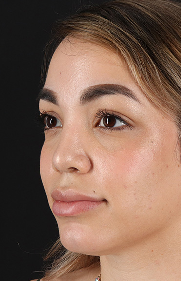 After - left_oblique