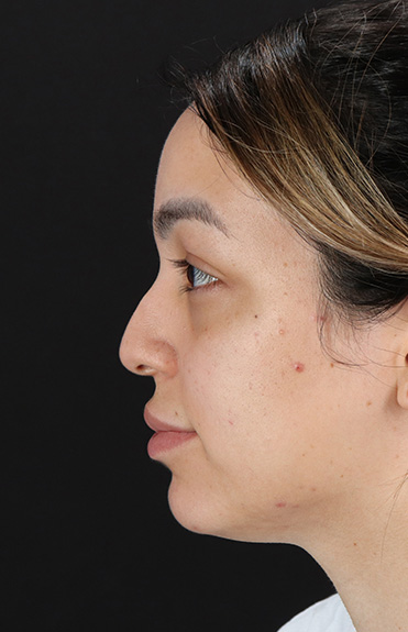 Before - left_lateral