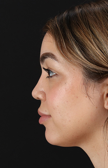 After - left_lateral