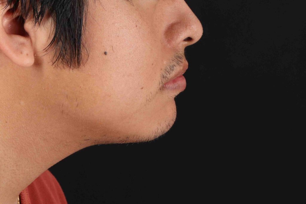 After - right_lateral