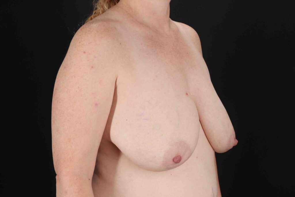 Before - right_oblique