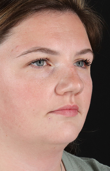 Before - right_oblique