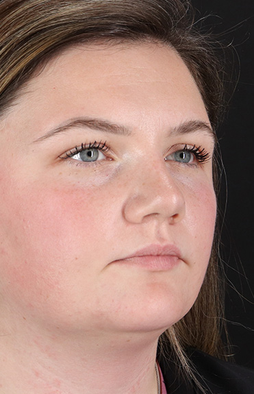 After - right_oblique