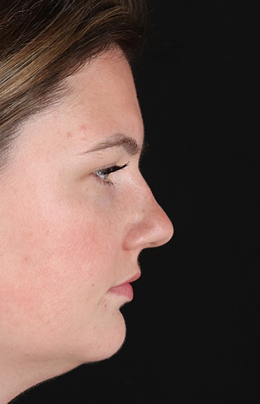 Before - right_lateral