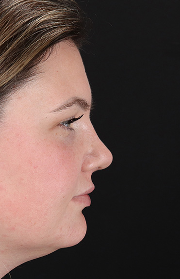 After - right_lateral