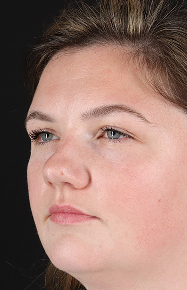 Before - left_oblique