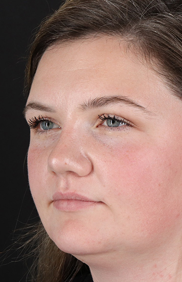 After - left_oblique