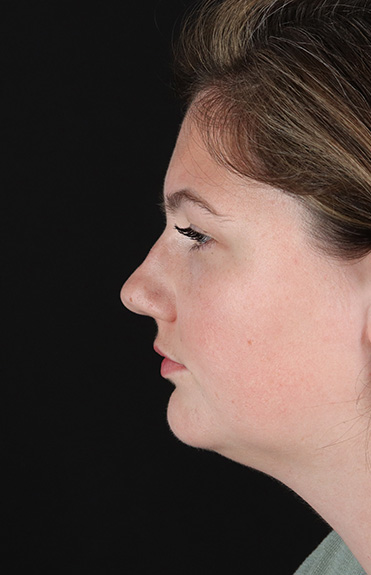 Before - left_lateral