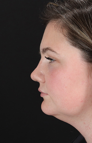 After - left_lateral