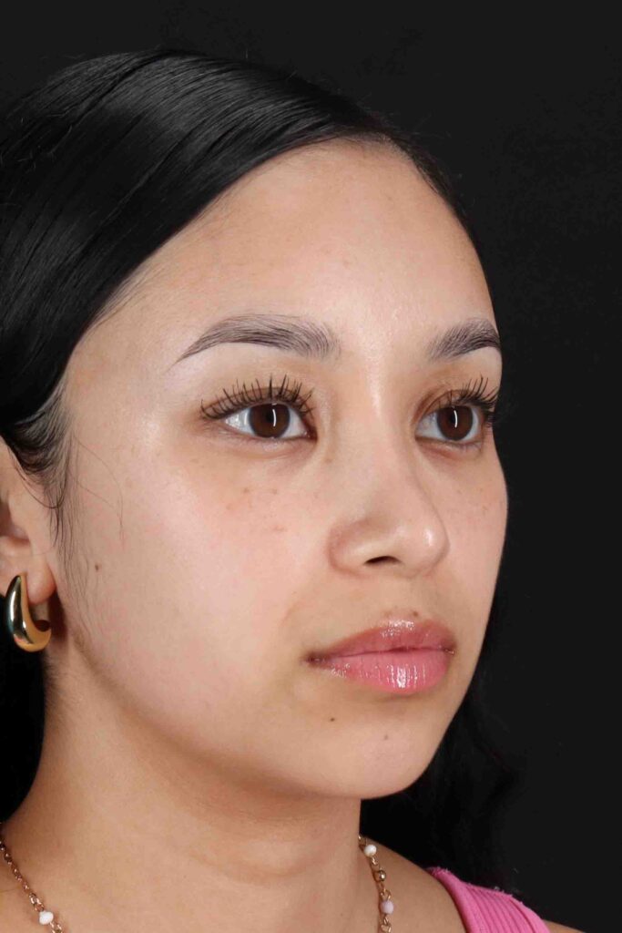 After - right_oblique