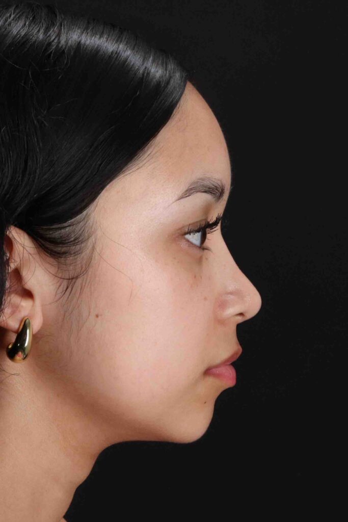 After - right_lateral